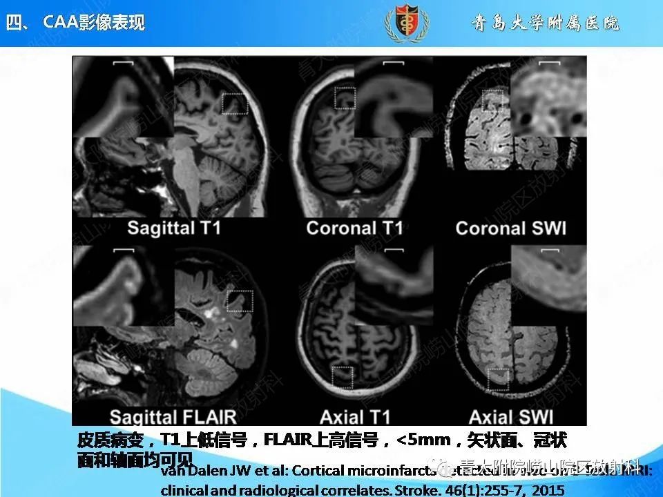 影像PPT - 【PPT】淀粉样脑血管病的影像诊断与鉴别诊断-48