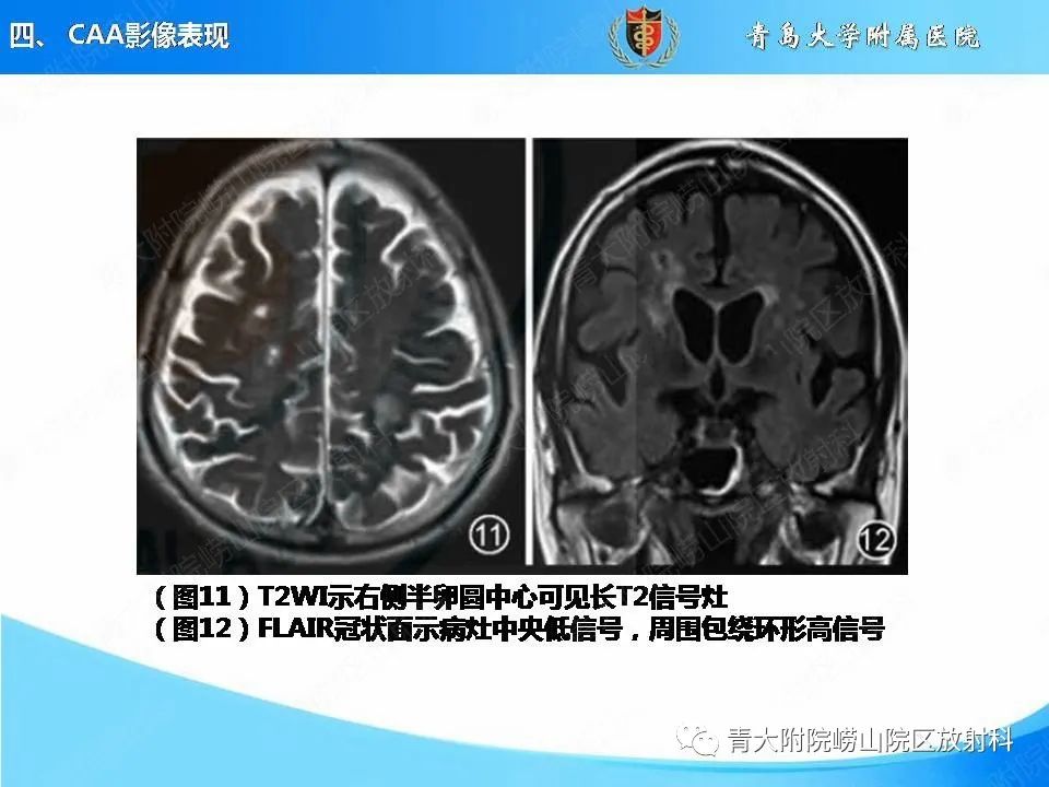 影像PPT - 【PPT】淀粉样脑血管病的影像诊断与鉴别诊断-50