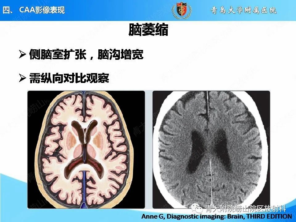 影像PPT - 【PPT】淀粉样脑血管病的影像诊断与鉴别诊断-51