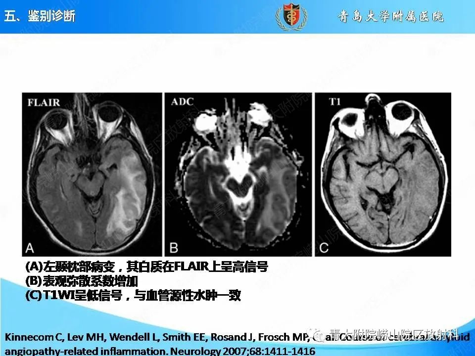 影像PPT - 【PPT】淀粉样脑血管病的影像诊断与鉴别诊断-53