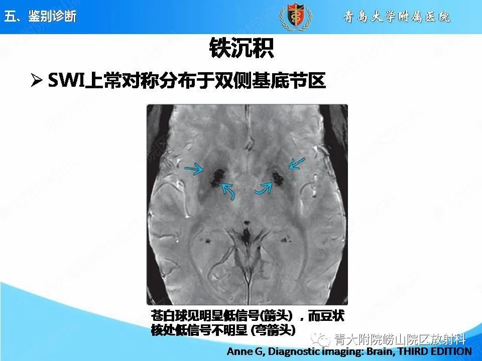 影像PPT - 【PPT】淀粉样脑血管病的影像诊断与鉴别诊断-57