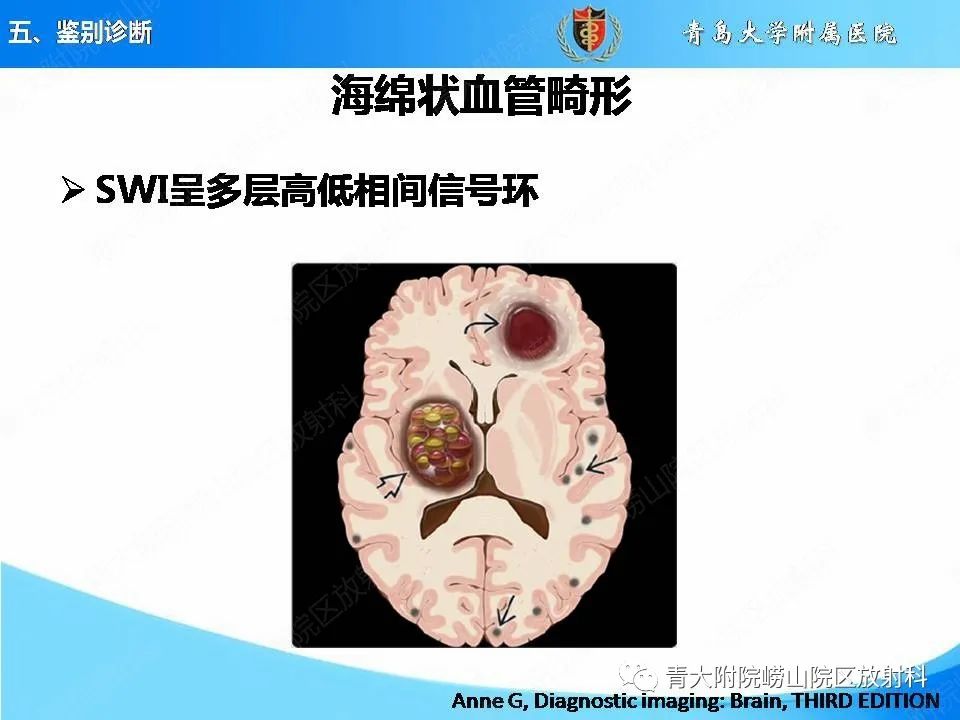 影像PPT - 【PPT】淀粉样脑血管病的影像诊断与鉴别诊断-58