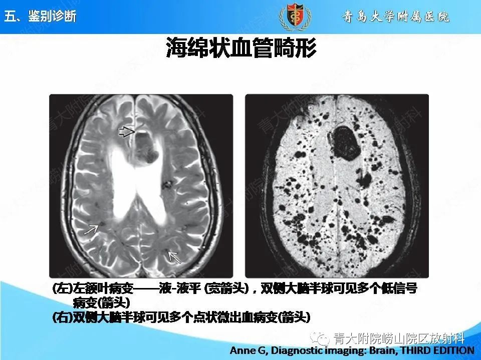 影像PPT - 【PPT】淀粉样脑血管病的影像诊断与鉴别诊断-59