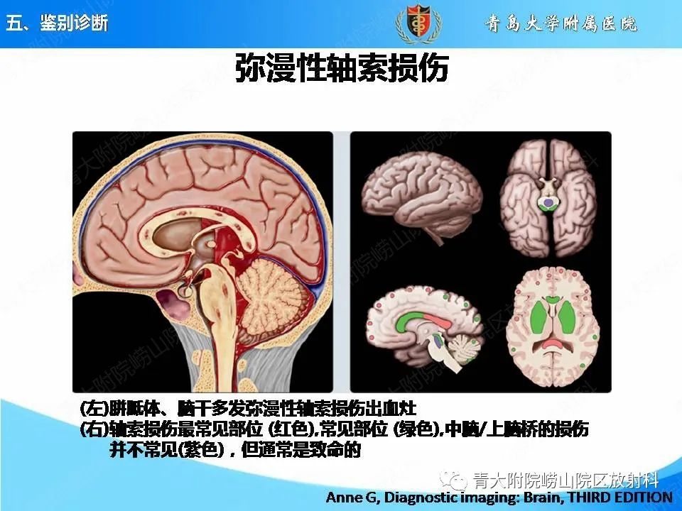 影像PPT - 【PPT】淀粉样脑血管病的影像诊断与鉴别诊断-61