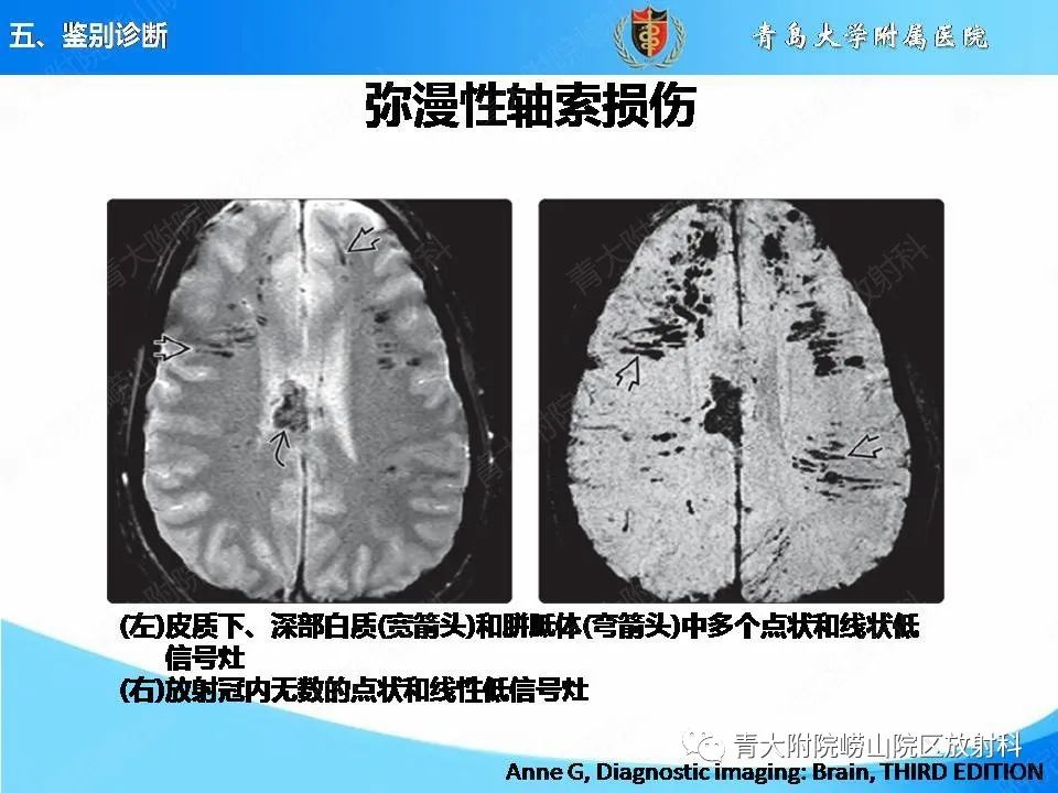 影像PPT - 【PPT】淀粉样脑血管病的影像诊断与鉴别诊断-62