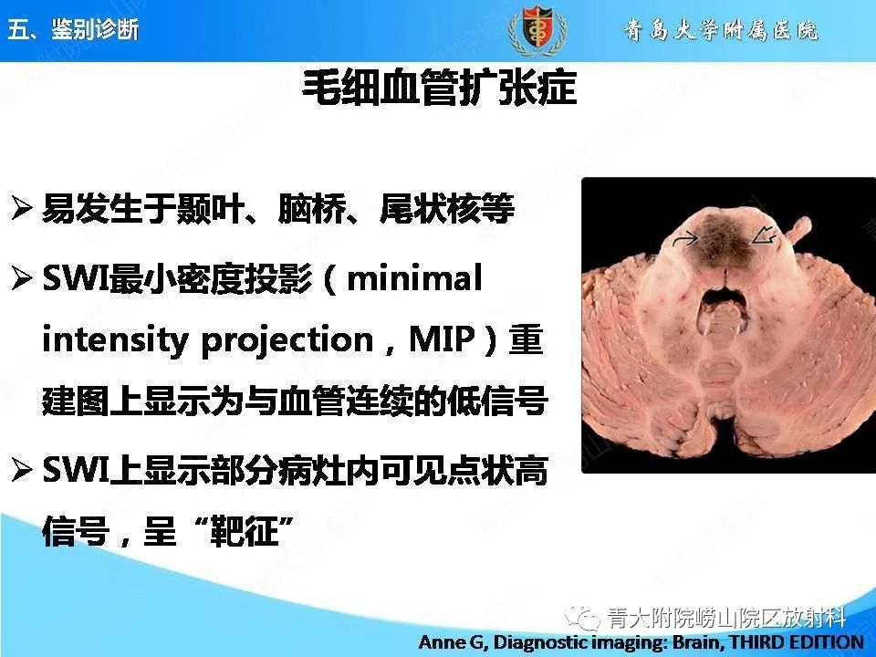 影像PPT - 【PPT】淀粉样脑血管病的影像诊断与鉴别诊断-63