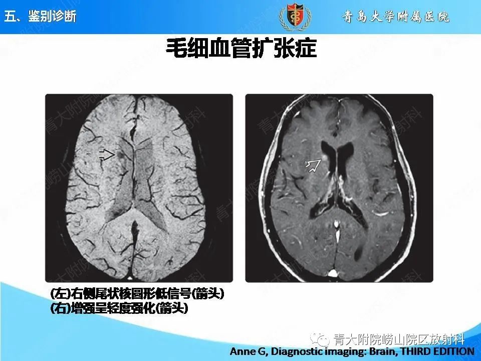 影像PPT - 【PPT】淀粉样脑血管病的影像诊断与鉴别诊断-64