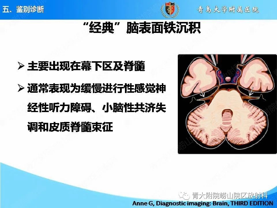 影像PPT - 【PPT】淀粉样脑血管病的影像诊断与鉴别诊断-65