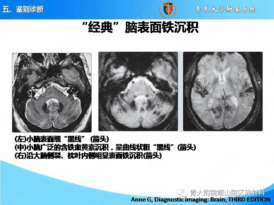 影像PPT - 【PPT】淀粉样脑血管病的影像诊断与鉴别诊断-67