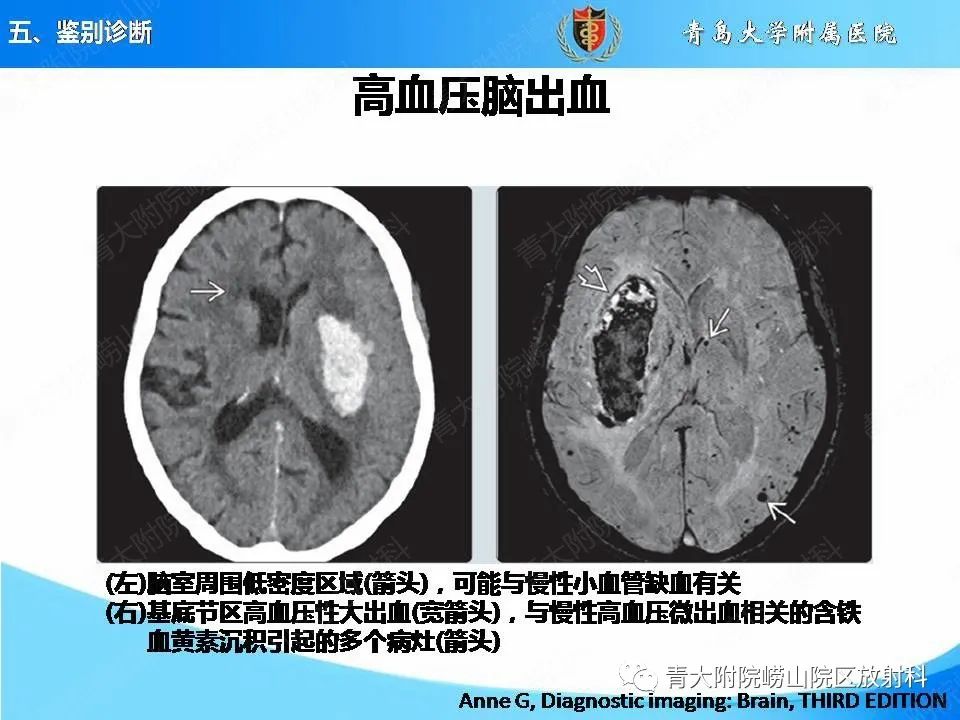 影像PPT - 【PPT】淀粉样脑血管病的影像诊断与鉴别诊断-69