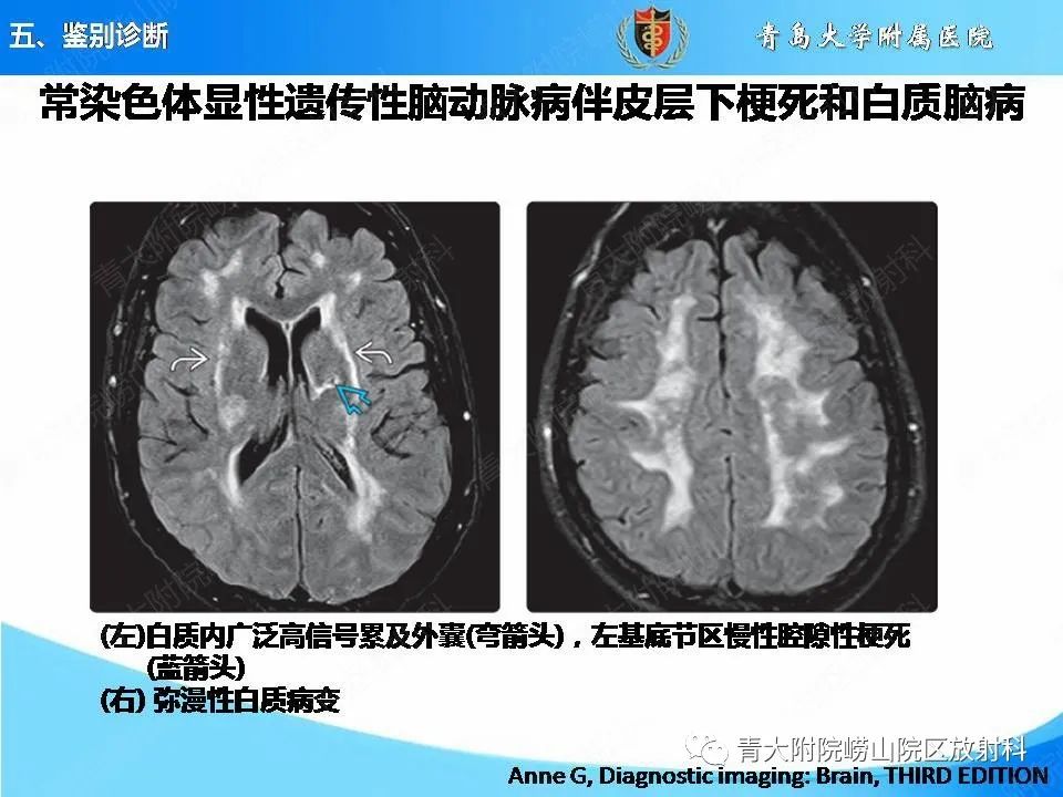 影像PPT - 【PPT】淀粉样脑血管病的影像诊断与鉴别诊断-72