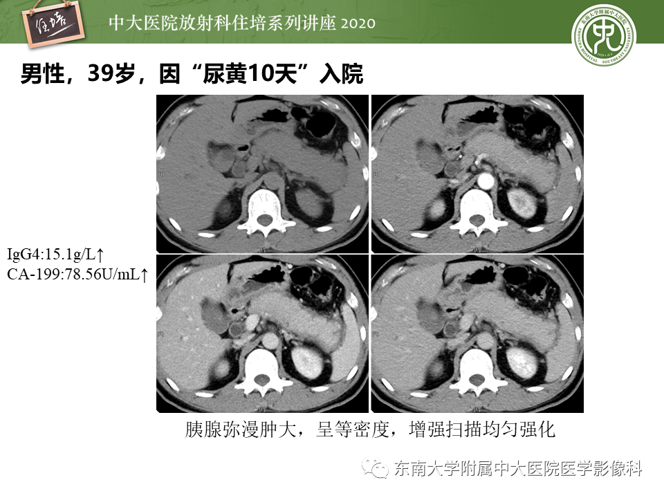 影像PPT - 【PPT】IgG4相关性疾病腹部脏器累及影像表现-12