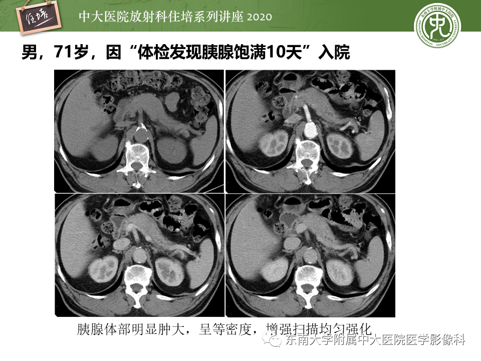 影像PPT - 【PPT】IgG4相关性疾病腹部脏器累及影像表现-13