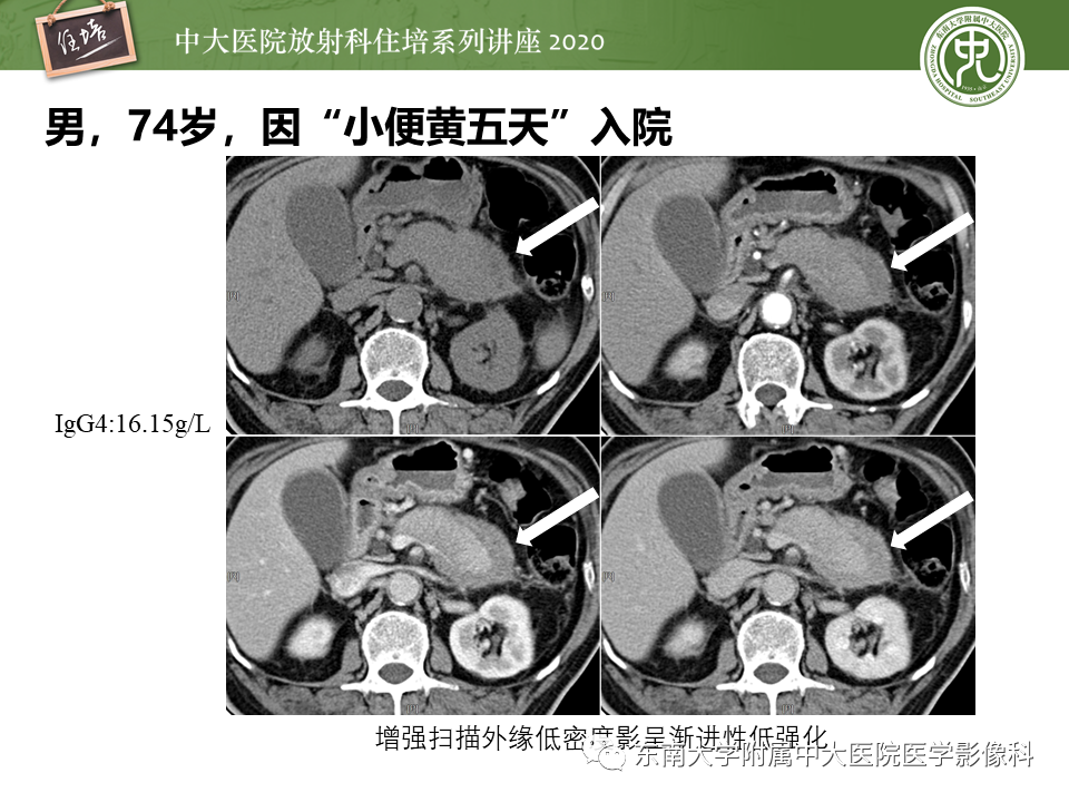 影像PPT - 【PPT】IgG4相关性疾病腹部脏器累及影像表现-15