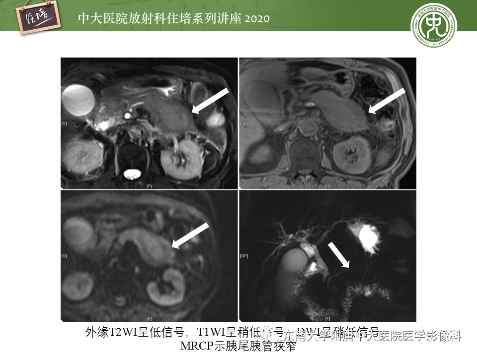 影像PPT - 【PPT】IgG4相关性疾病腹部脏器累及影像表现-16