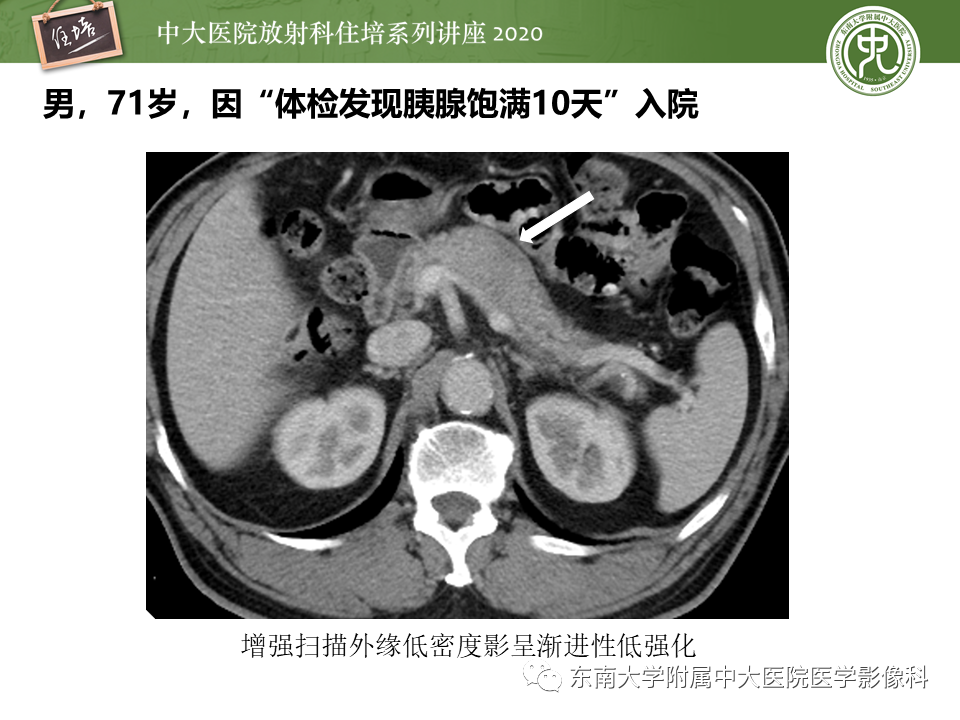 影像PPT - 【PPT】IgG4相关性疾病腹部脏器累及影像表现-18