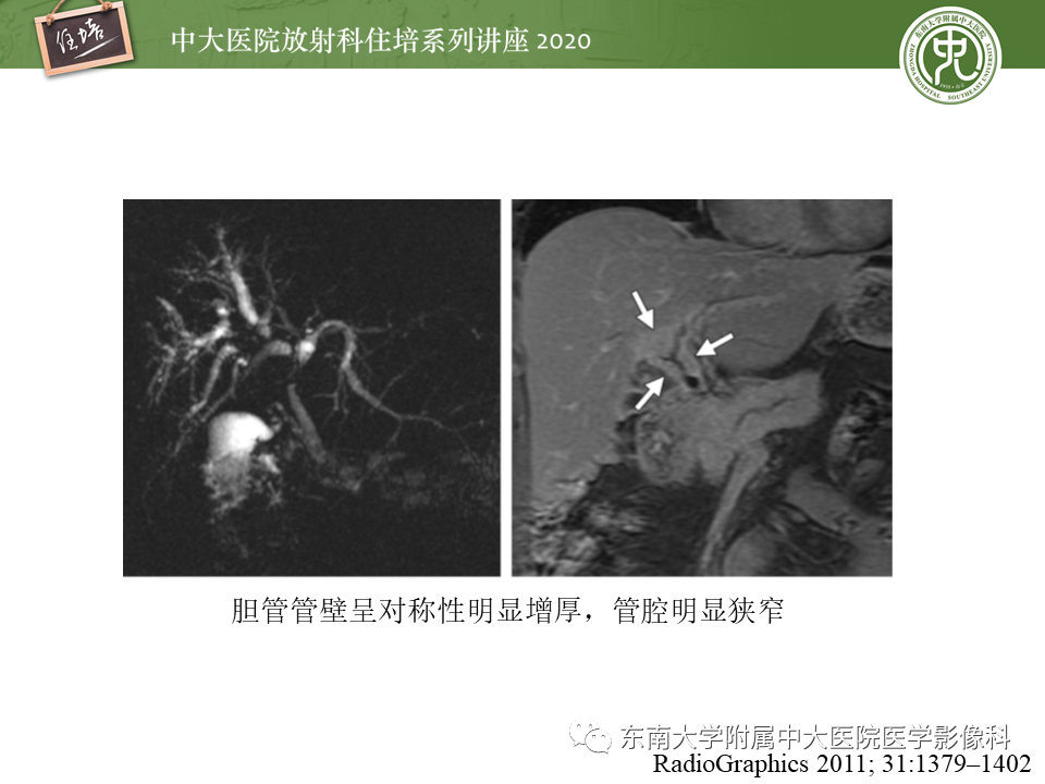 影像PPT - 【PPT】IgG4相关性疾病腹部脏器累及影像表现-22