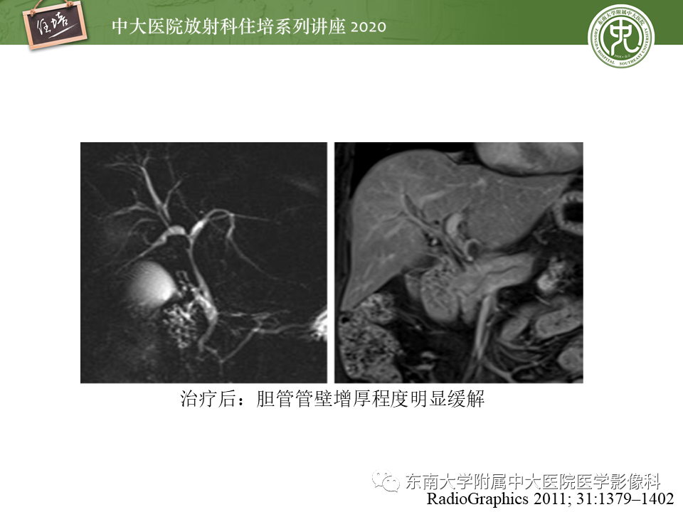 影像PPT - 【PPT】IgG4相关性疾病腹部脏器累及影像表现-23