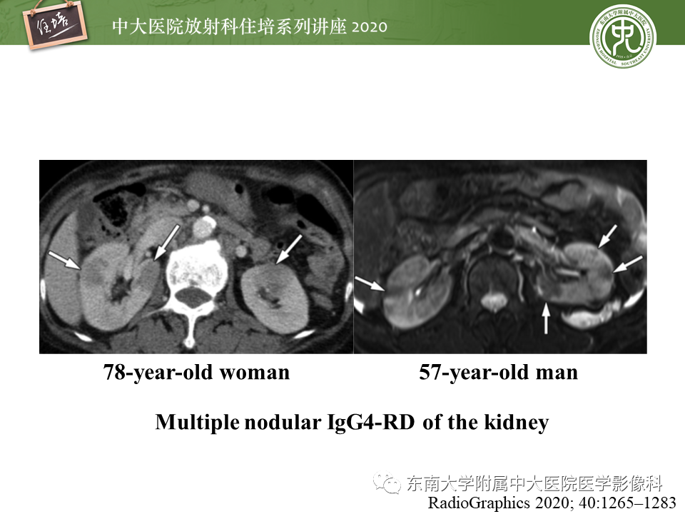 影像PPT - 【PPT】IgG4相关性疾病腹部脏器累及影像表现-26