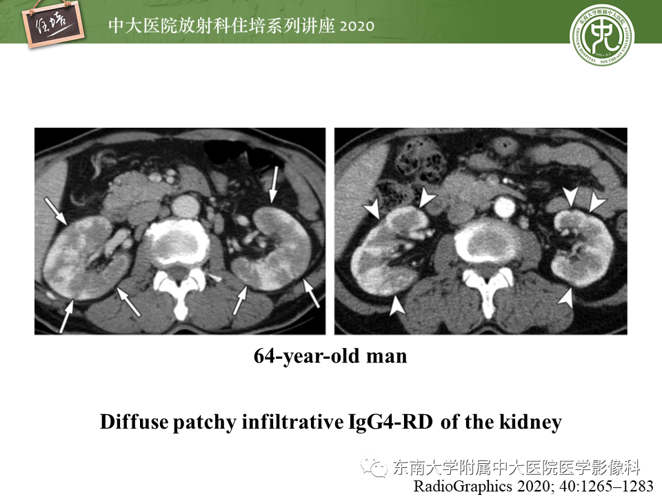 影像PPT - 【PPT】IgG4相关性疾病腹部脏器累及影像表现-27