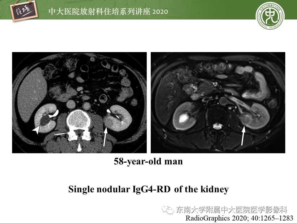 影像PPT - 【PPT】IgG4相关性疾病腹部脏器累及影像表现-28