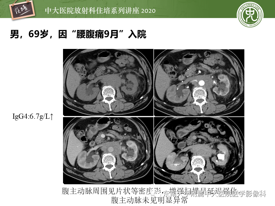 影像PPT - 【PPT】IgG4相关性疾病腹部脏器累及影像表现-32