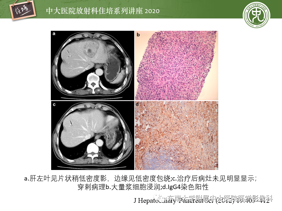 影像PPT - 【PPT】IgG4相关性疾病腹部脏器累及影像表现-35