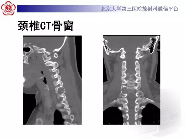 影像PPT - 【PPT】脊柱腱鞘巨细胞瘤TGCT影像-3