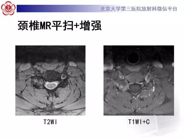影像PPT - 【PPT】脊柱腱鞘巨细胞瘤TGCT影像-6