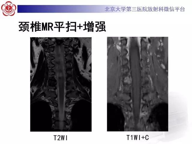 影像PPT - 【PPT】脊柱腱鞘巨细胞瘤TGCT影像-7