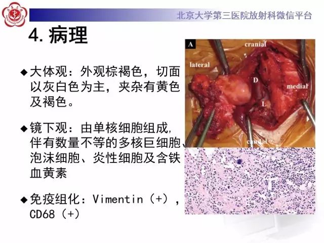 影像PPT - 【PPT】脊柱腱鞘巨细胞瘤TGCT影像-15