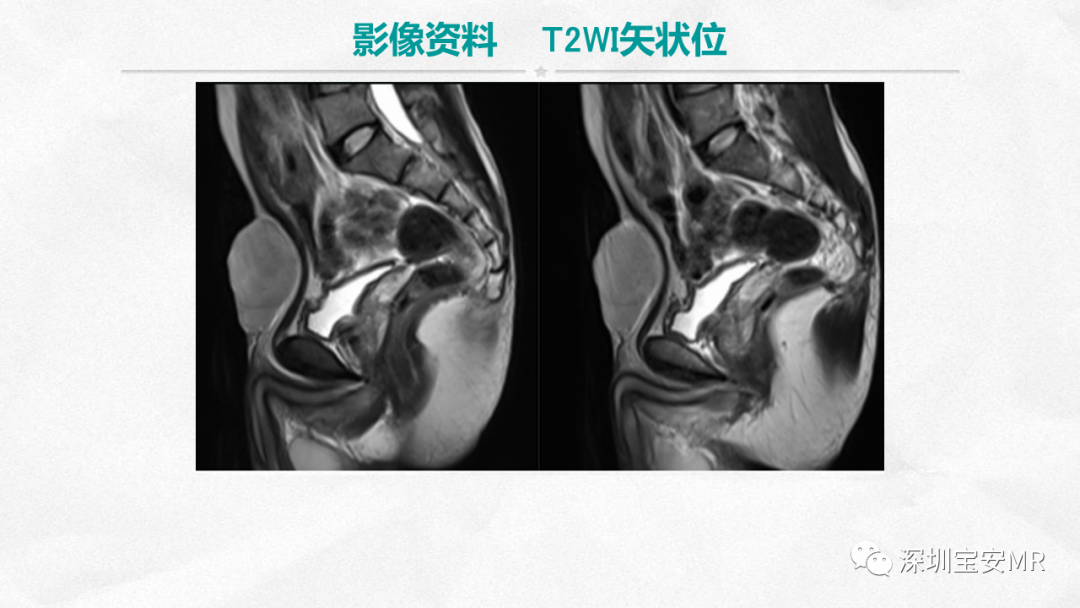 影像PPT - 【PPT】隆突性皮肤纤维肉瘤-4