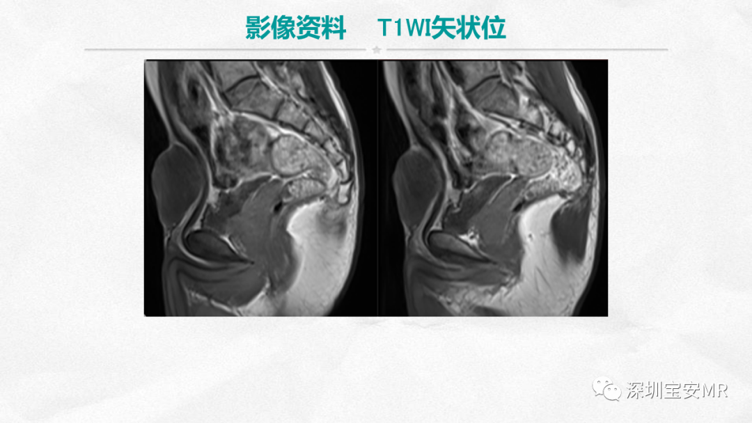 影像PPT - 【PPT】隆突性皮肤纤维肉瘤-5