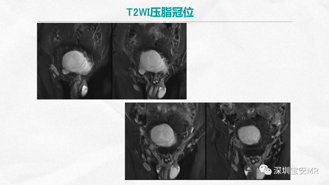 影像PPT - 【PPT】隆突性皮肤纤维肉瘤-6