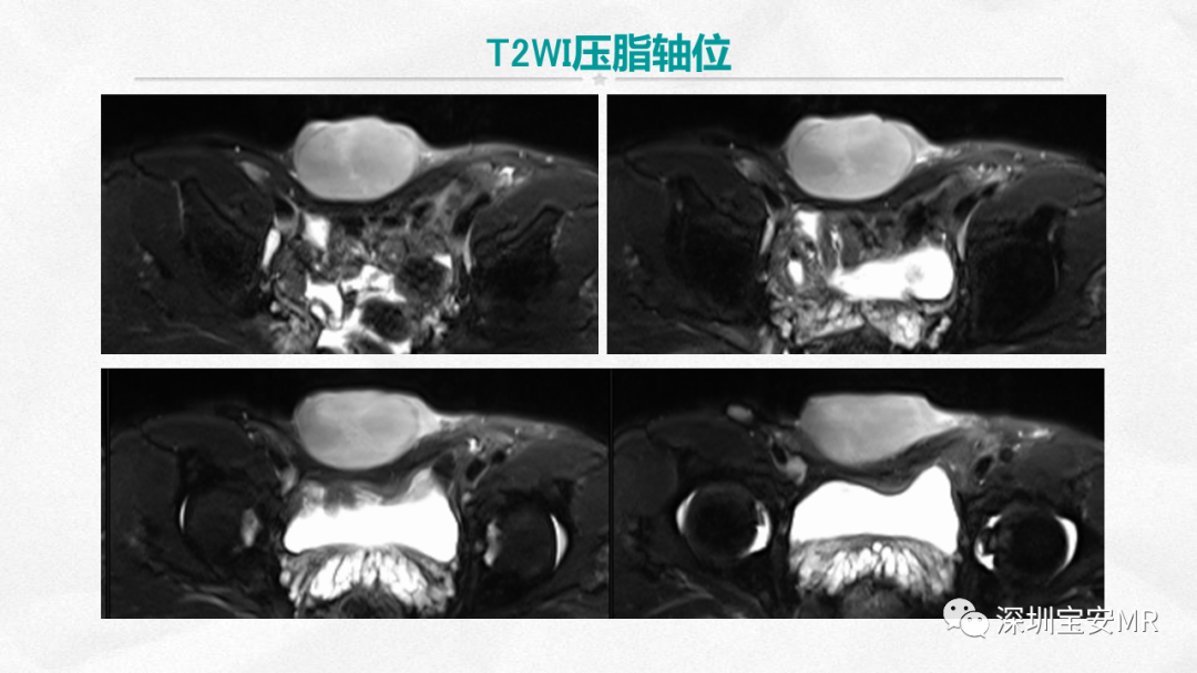 影像PPT - 【PPT】隆突性皮肤纤维肉瘤-7