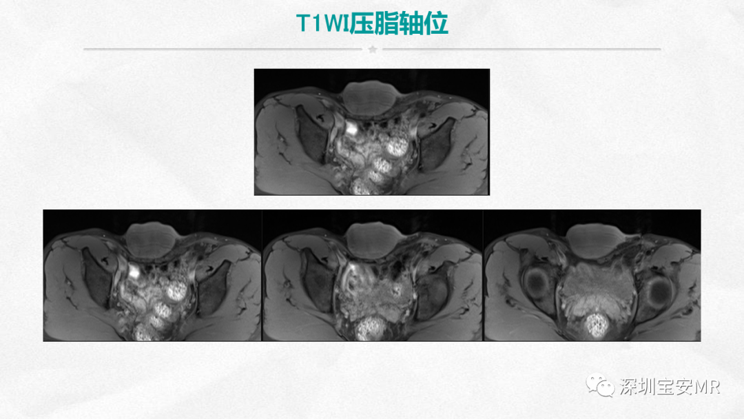 影像PPT - 【PPT】隆突性皮肤纤维肉瘤-8