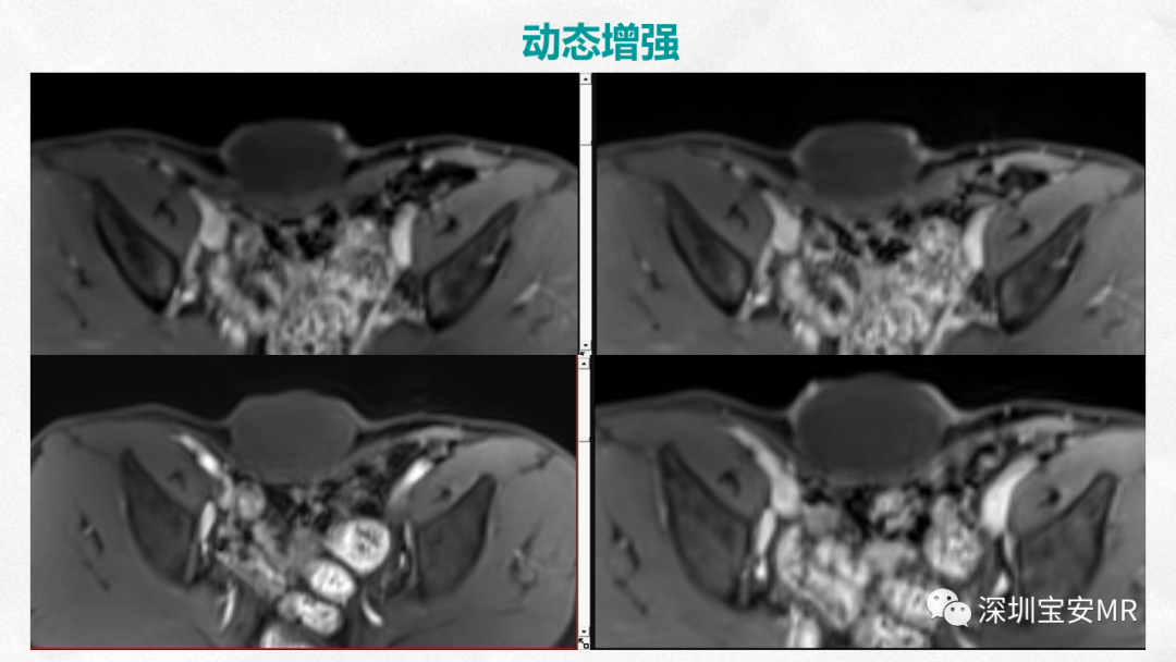 影像PPT - 【PPT】隆突性皮肤纤维肉瘤-10