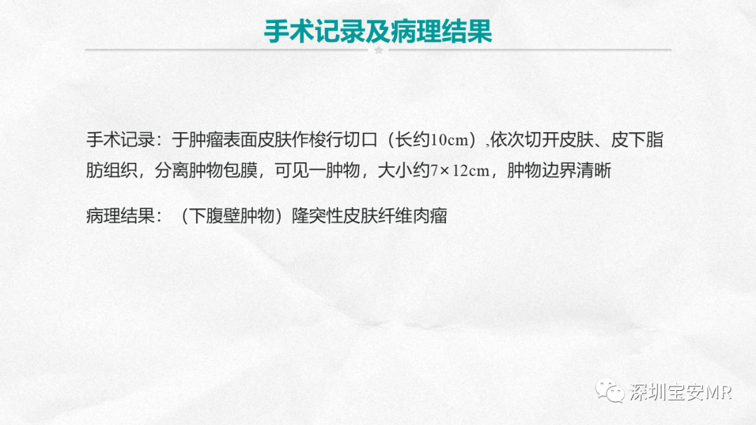 影像PPT - 【PPT】隆突性皮肤纤维肉瘤-13
