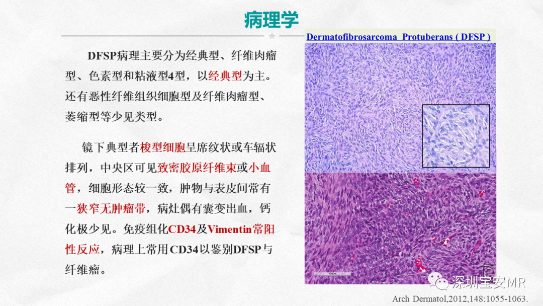 影像PPT - 【PPT】隆突性皮肤纤维肉瘤-16