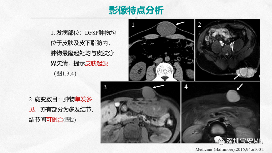 影像PPT - 【PPT】隆突性皮肤纤维肉瘤-17