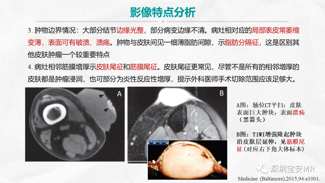 影像PPT - 【PPT】隆突性皮肤纤维肉瘤-18