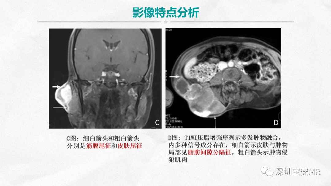 影像PPT - 【PPT】隆突性皮肤纤维肉瘤-19