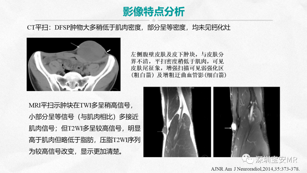 影像PPT - 【PPT】隆突性皮肤纤维肉瘤-20