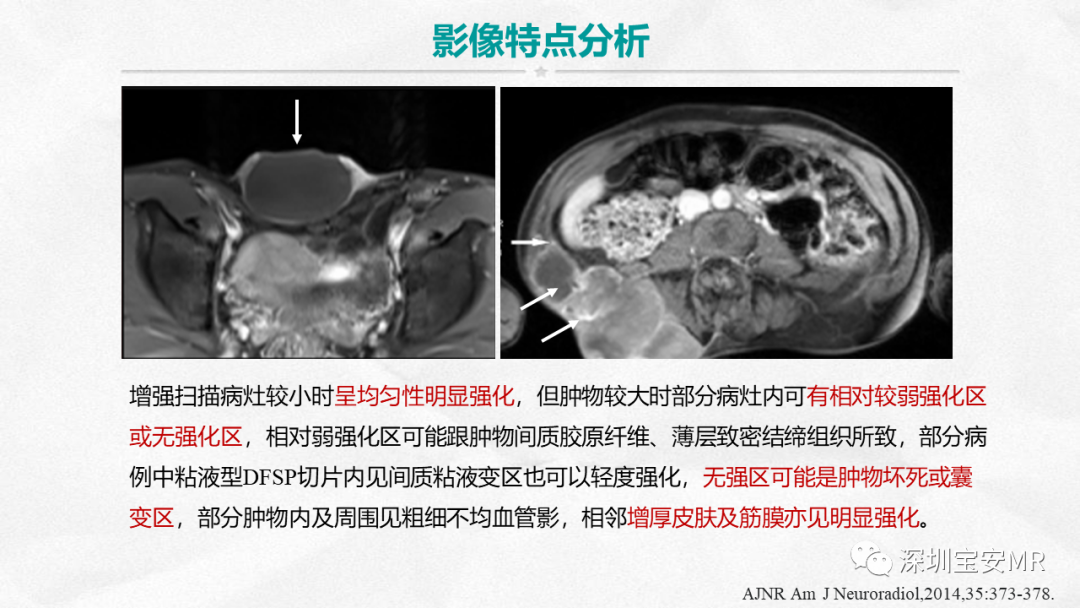 影像PPT - 【PPT】隆突性皮肤纤维肉瘤-21