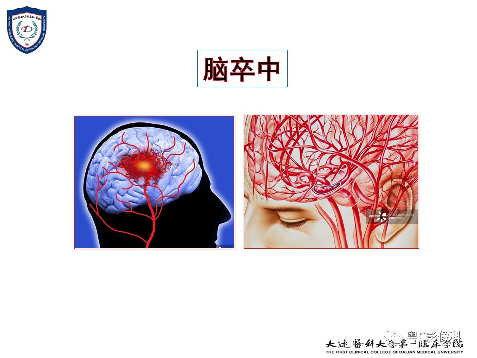 影像PPT - 【PPT】急性脑卒中影像学评估中容易被忽略的征象-2