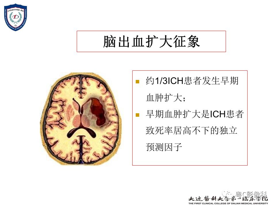 影像PPT - 【PPT】急性脑卒中影像学评估中容易被忽略的征象-10