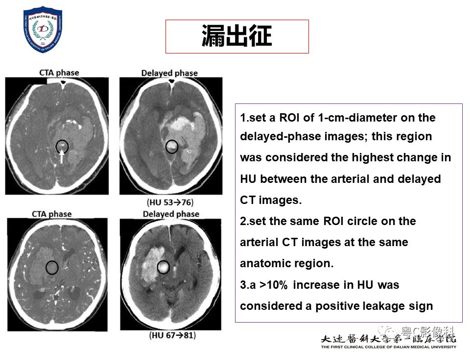 影像PPT - 【PPT】急性脑卒中影像学评估中容易被忽略的征象-13