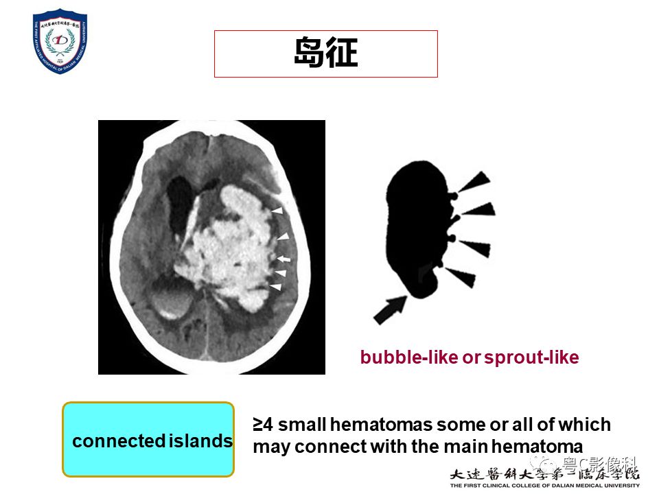 影像PPT - 【PPT】急性脑卒中影像学评估中容易被忽略的征象-15