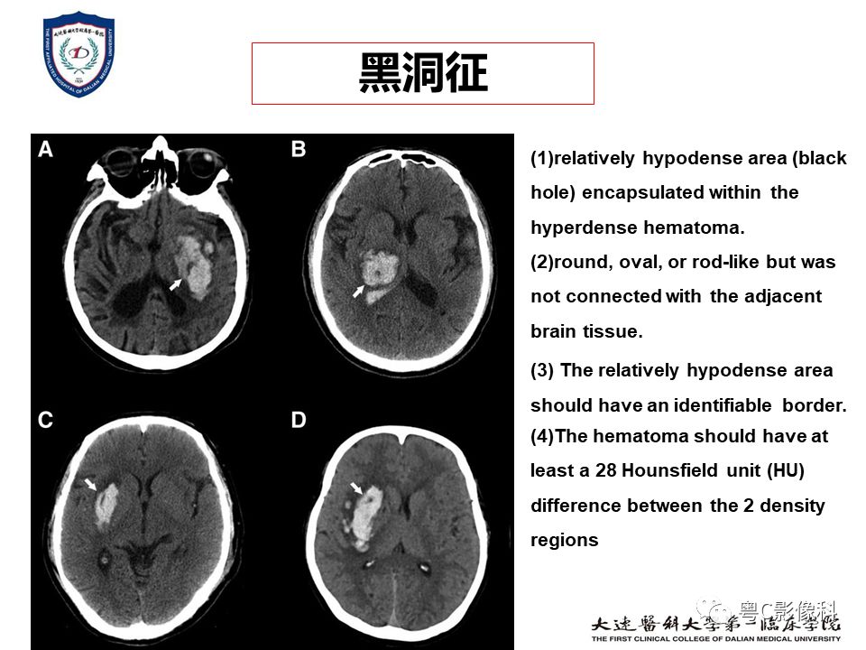 影像PPT - 【PPT】急性脑卒中影像学评估中容易被忽略的征象-16