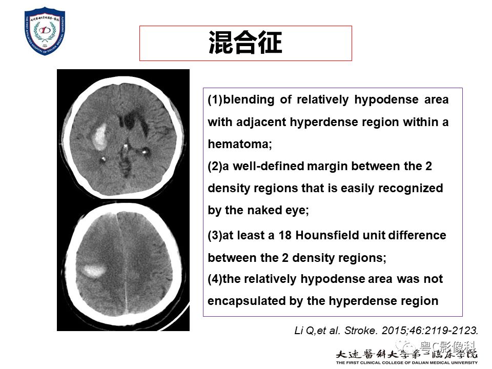 影像PPT - 【PPT】急性脑卒中影像学评估中容易被忽略的征象-17